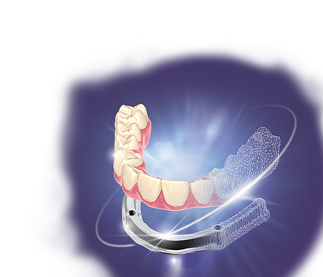 exocad PartialCAD 3.3 Automates Split-Denture Design—But Speed Is Not the Same as Passive Fit