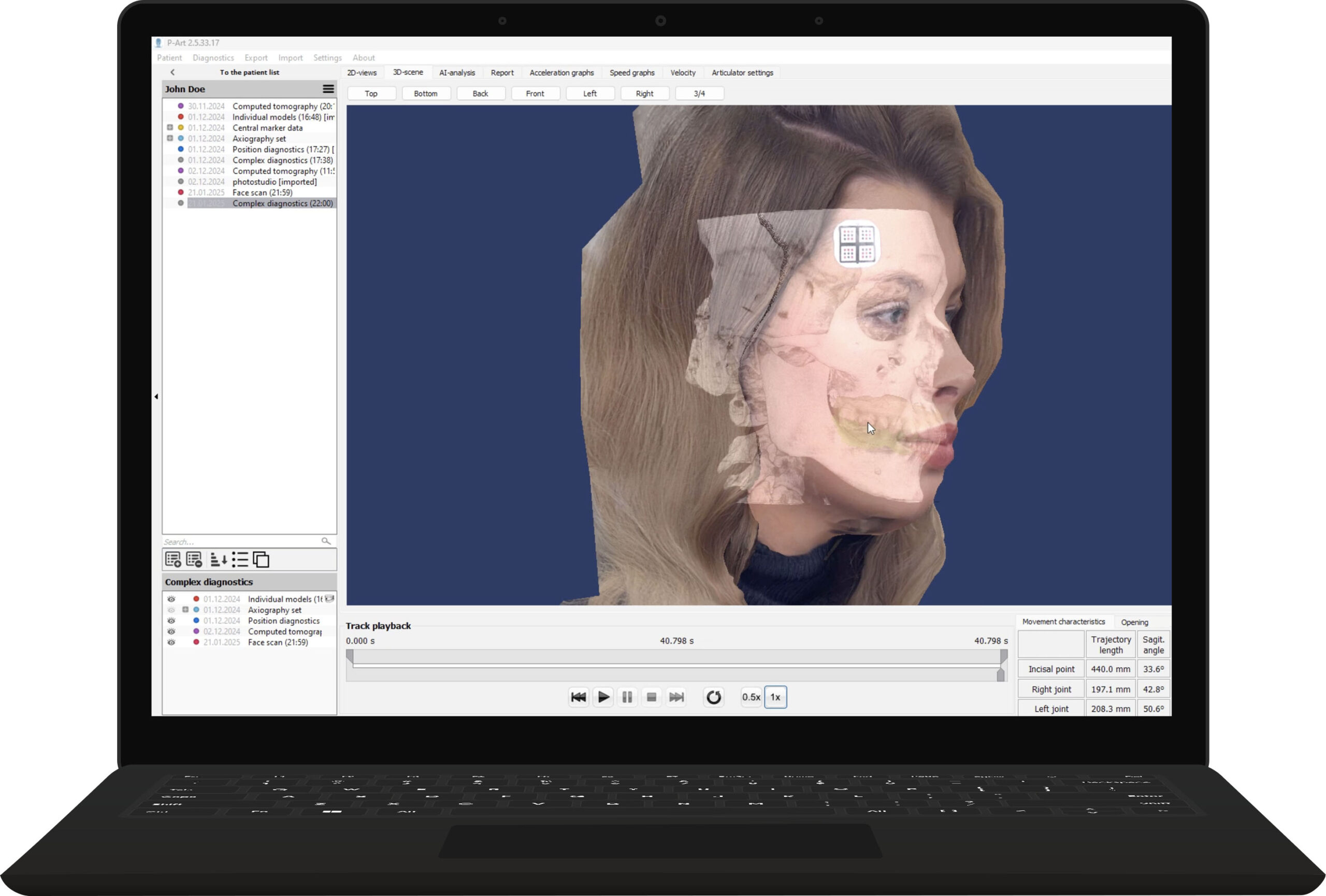 SDI Matrix Is Bringing Jaw Tracking, Muscle Analysis and Exocad-Ready Planning Into One Workflow