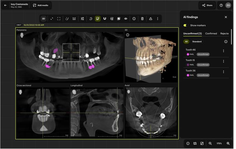 Dentsply Sirona’s Smart View Detect Is FDA-Cleared for CBCT AI—But Its Indication Is Narrower Than the Headline